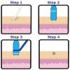 Skin Tag Removal Device, Mole Removal, Corn Removal